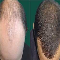 Transplante de pelo