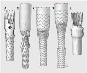 Branched Stent Grafts Tendencias de crecimiento del mercado