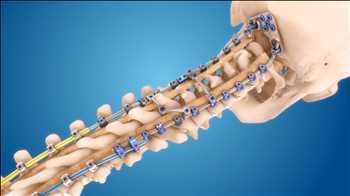 Global Producto de cirugía de columna Jugadores líderes del mercado