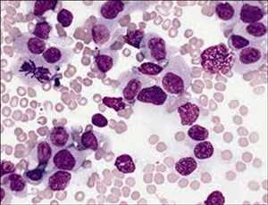 Global-Acute-Myeloid-Leukemia-Treatment-Market