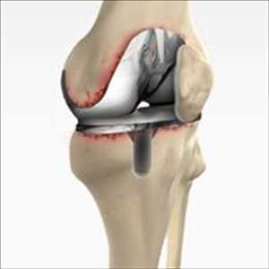 Global-Artificial-Knee-Joint-Market