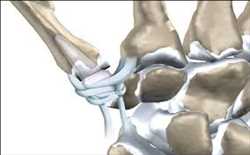 Tendones y ligamentos artificiales