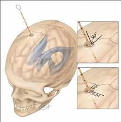 Mercado mundial de drenaje ventricular externo