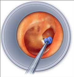 Mercado mundial de tubos de timpanostomía