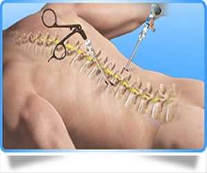 Análisis del mercado mundial de dispositivos de cirugía de columna