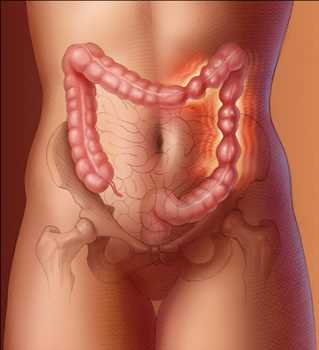 Diagnóstico del síndrome del intestino irritable (SII) Mercado