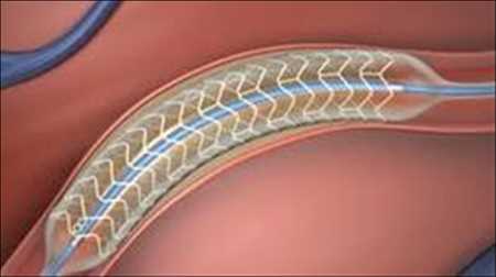 Stent cardíaco absorbible Mercado