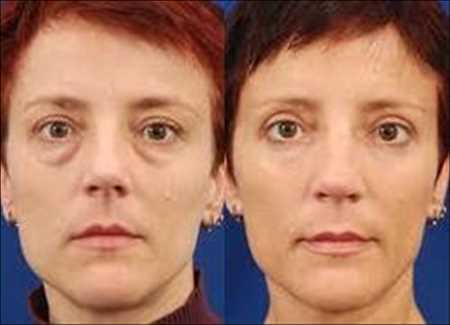 Blefaroplastia Mercado