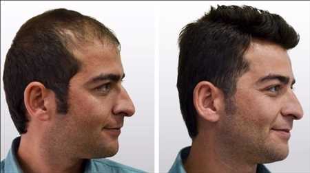 Transplante de pelo Mercado